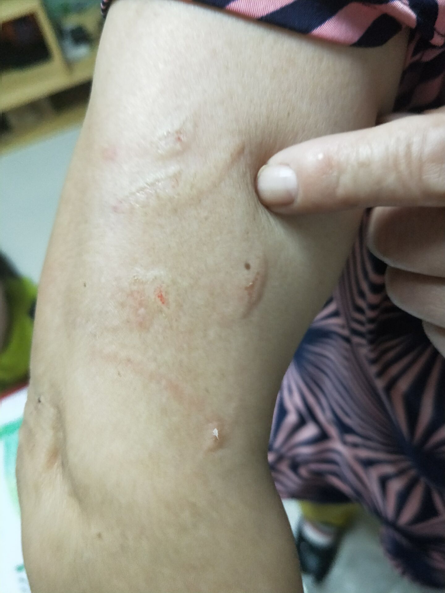 打的老奶奶胳膊浮肿
