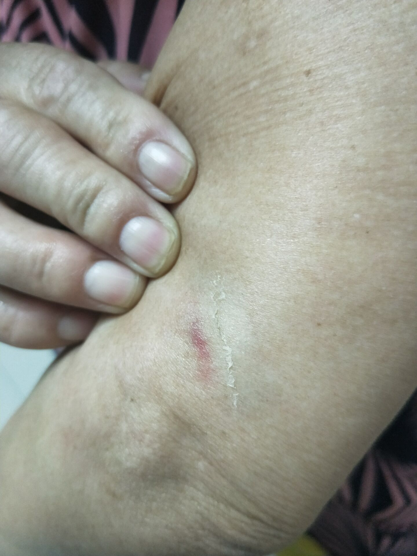 胳膊铁青