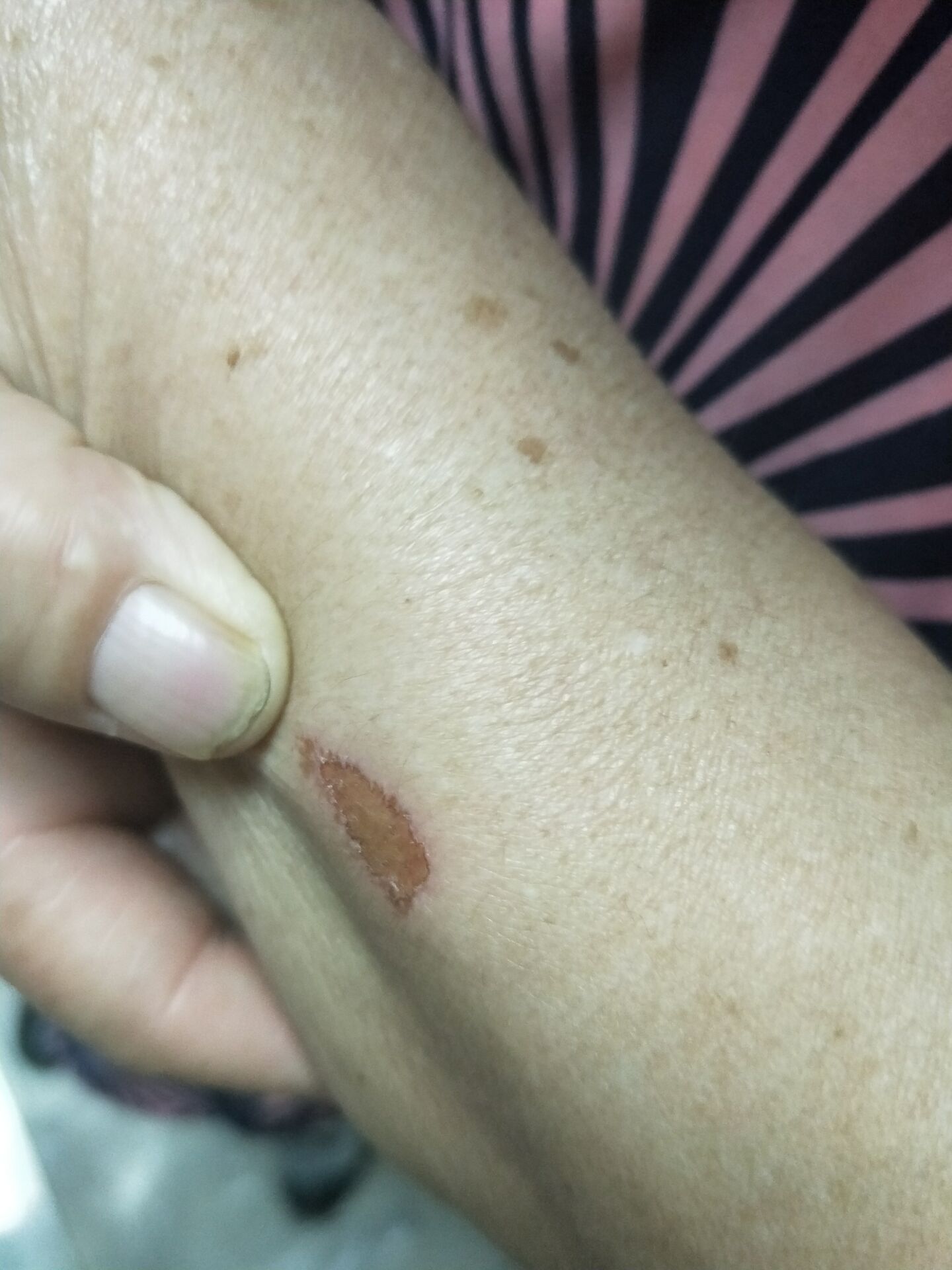 抠破了皮